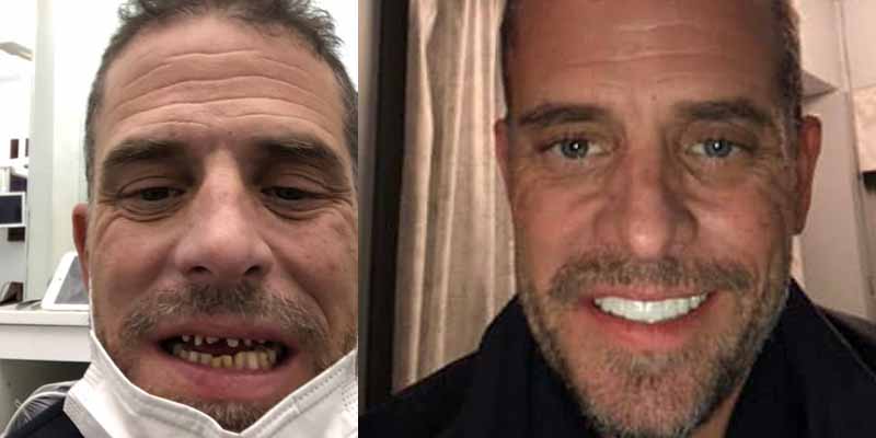 Hunterit hampaat kannattaa näyttää lapsille - meth mouth on hampilääkäreiden käyttämä termi hunterhampaista.jpg