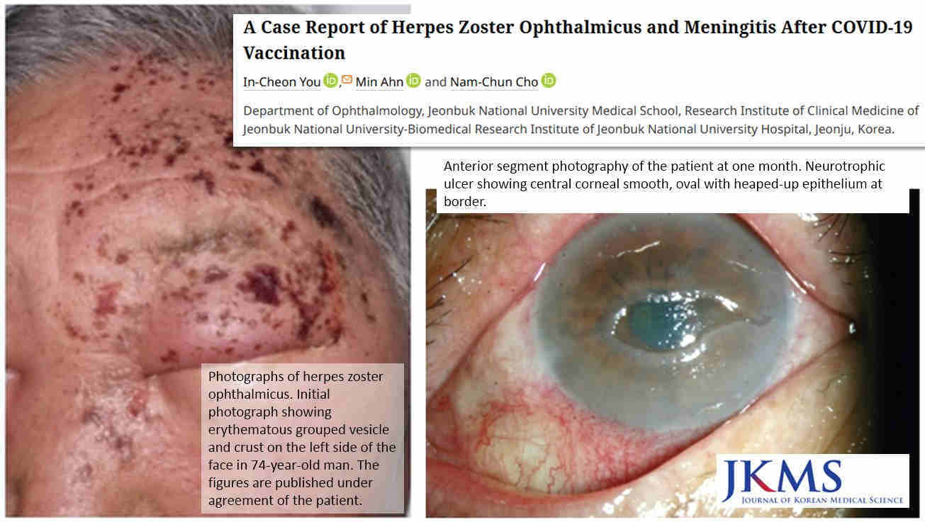 Herpes zoster ophtalmicus ja aivokalvontulehdus C19-injektion jälkeen.jpeg